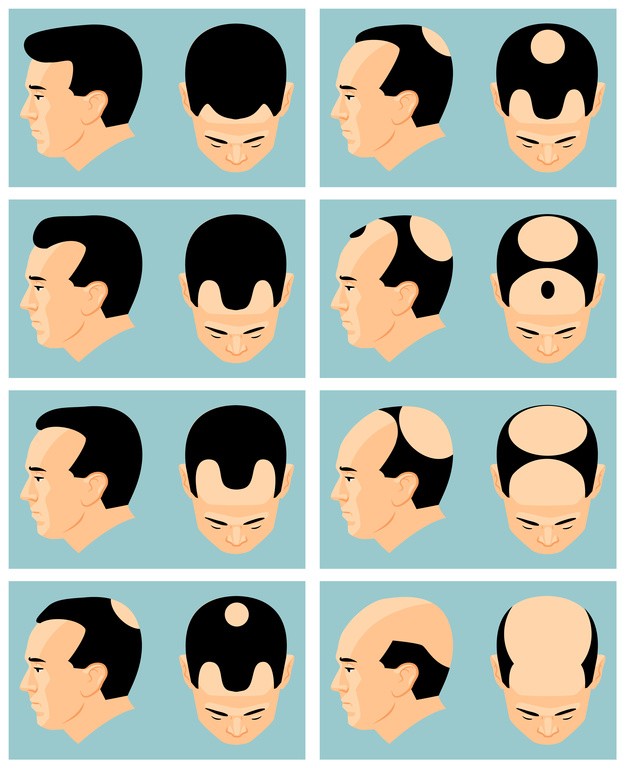 Pigmentazione capelli - Pigmentazione capelli