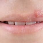 Trucco permanente labbra e herpes
