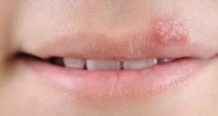 Trucco permanente labbra e herpes
