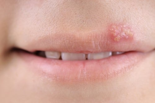 Trucco permanente labbra e herpes - Trucco permanente labbra e herpes