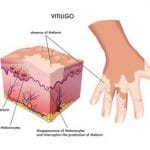 Un rimedio per la vitiligine