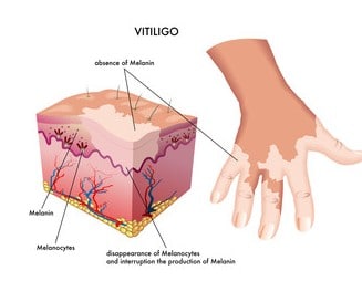 Un rimedio per la vitiligine - Un rimedio per la vitiligine
