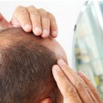 rimedio per alopecia