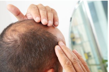 Un Rimedio per Alopecia rimedio per alopecia - Un Rimedio per Alopecia