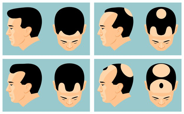 tricopigmentazione capelli